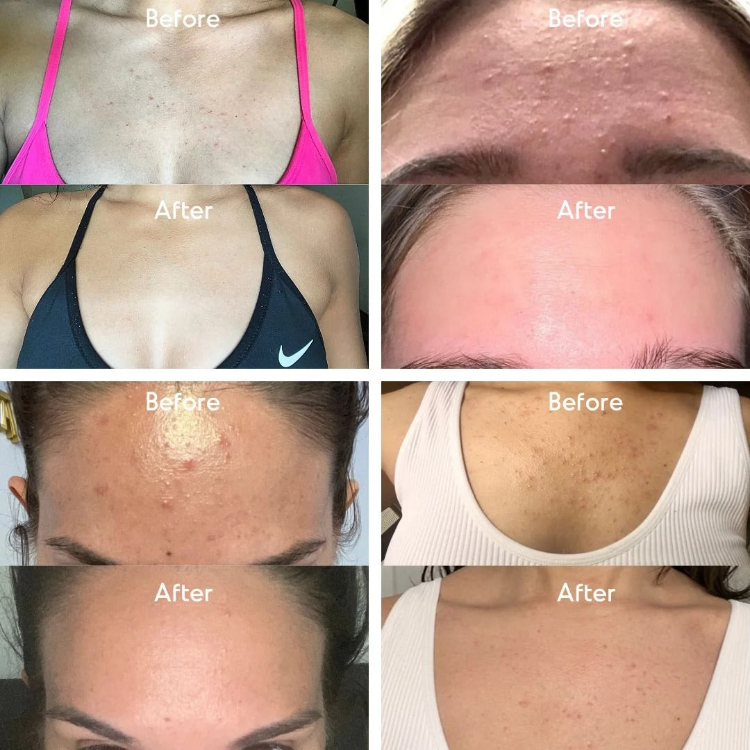 Mandelic Acid Level 2 Body Serum - Extra Strength Acne & Spot Treatment