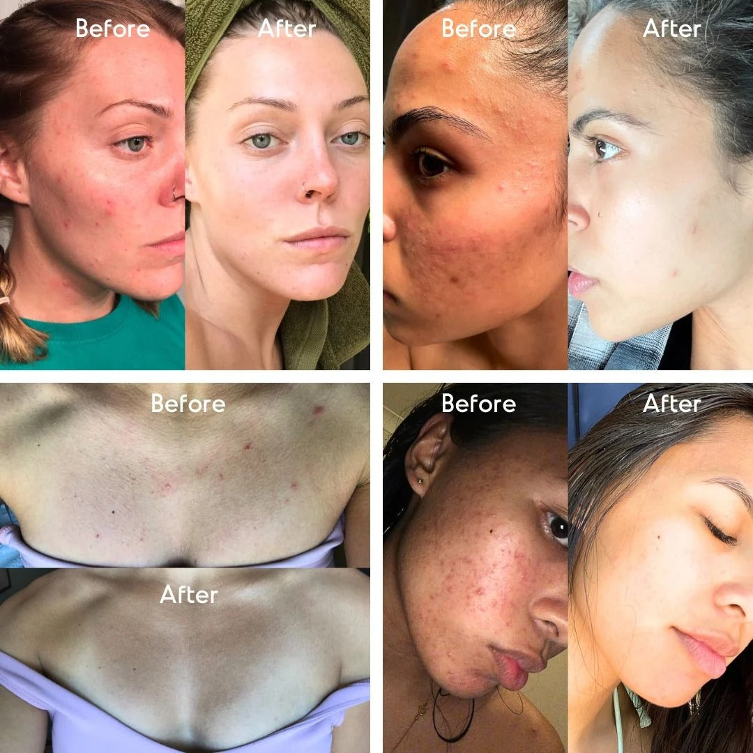 Mandelic Acid Level 2 Body Serum - Extra Strength Acne & Spot Treatment