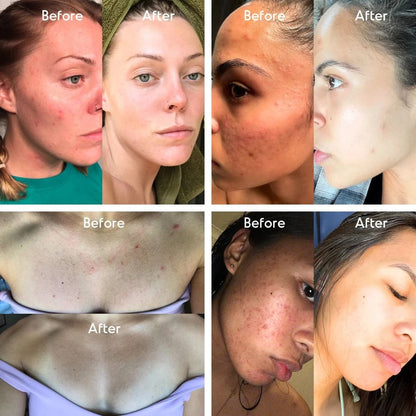 Mandelic Acid Level 2 Body Serum - Extra Strength Acne & Spot Treatment